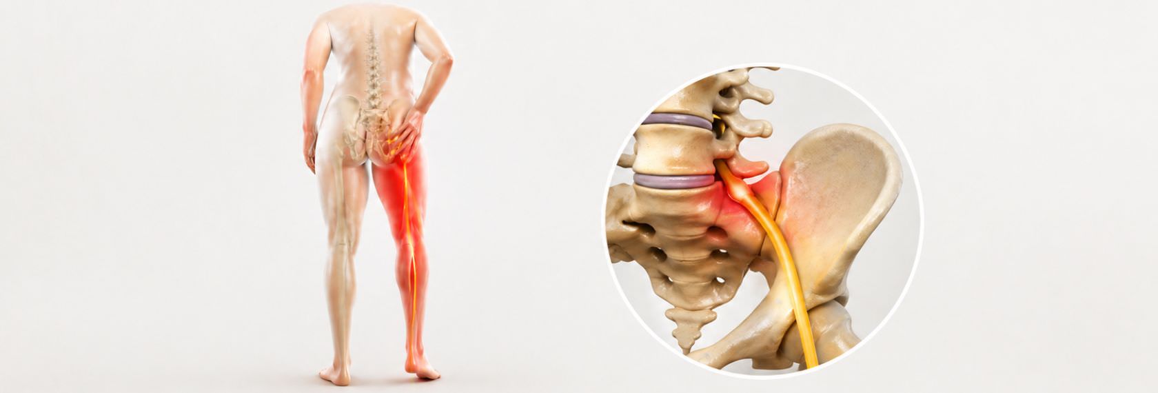 Trattamento osteopatico per la sciatica